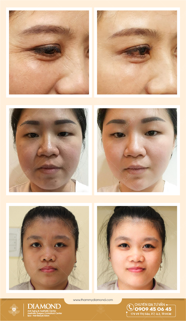 Hiệu quả sau khi điều trị trẻ hóa da mặt bằng công nghệ Hifu 2018