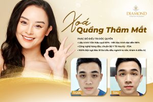 Cách trị quầng thâm mắt