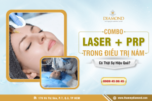 Combo laser và PRP trong điều trị nám
