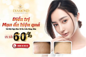 Điều trị mụn ẩn hiệu quả