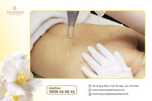 Điều trị viêm nang lông