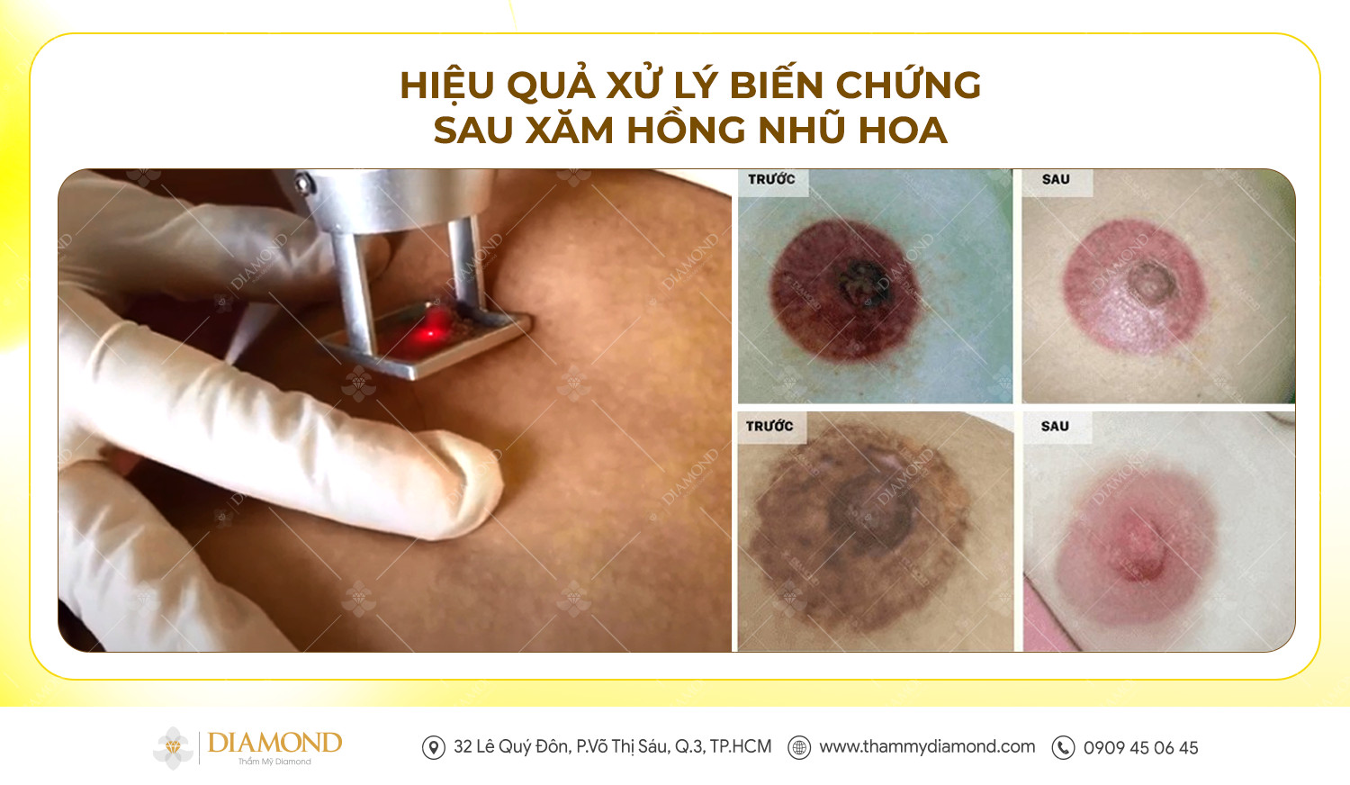 Hiệu quả xử lý biến chứng sau xăm hồng nhũ hoa