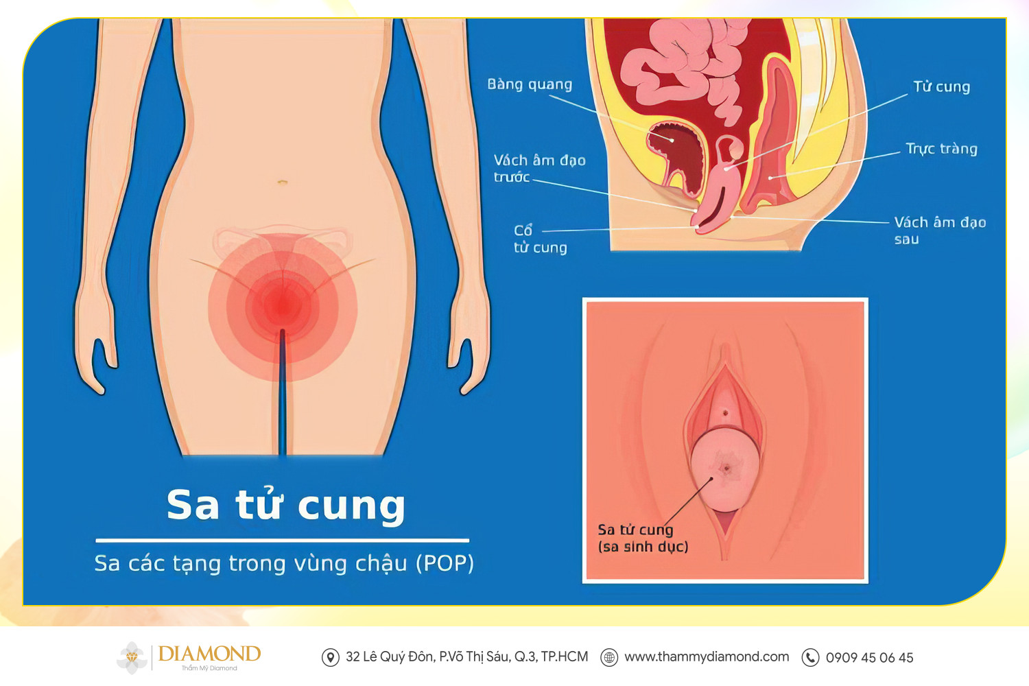 Sa tử cung - Sa các tạng trong vùng chậu