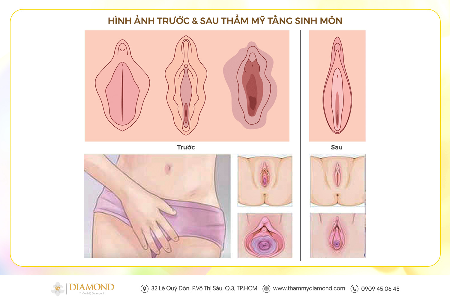 Hình ảnh trước & sau thẩm mỹ tầng sinh môn