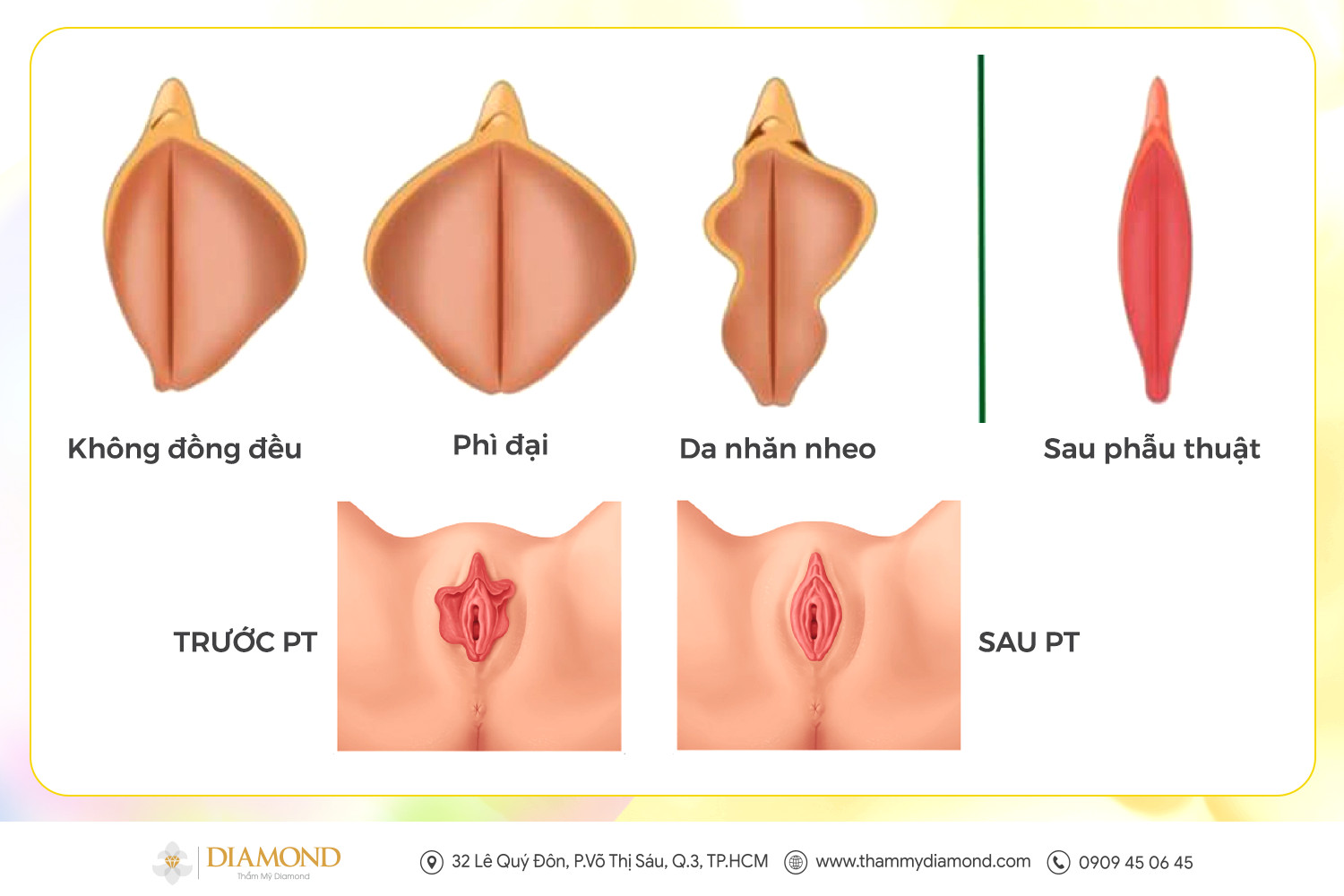 Ưu điểm khi thẩm mỹ tầng sinh môn