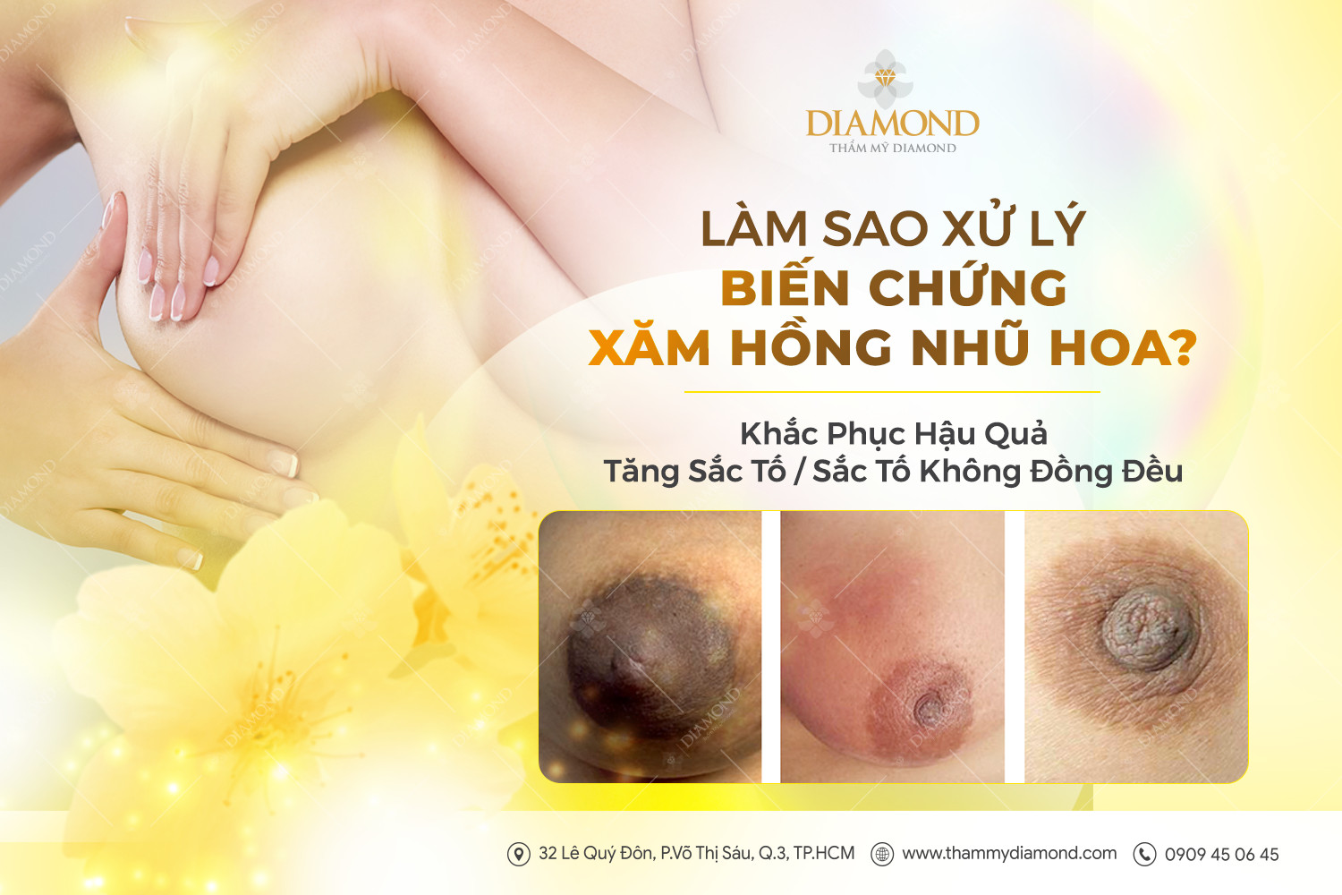 Làm sao xử lý biến chứng xăm hồng nhũ hoa
