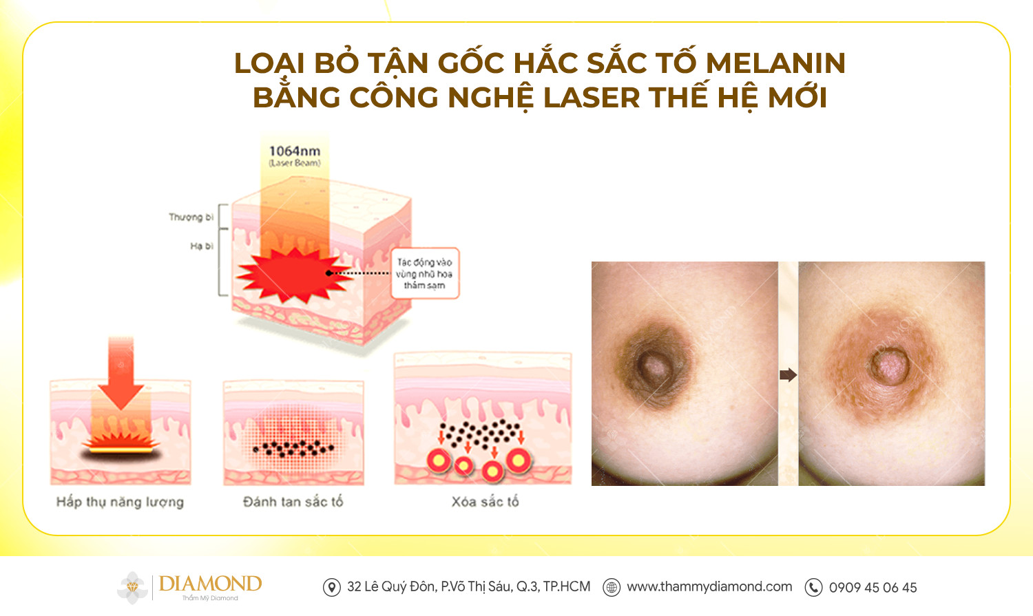 Loại bỏ tận gốc hắc sắc tố Melanin bằng công nghệ laser