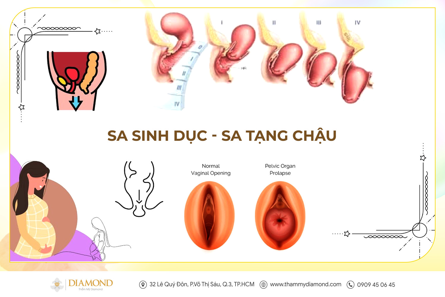 Sa sinh dục - Sa tạng chậu