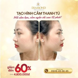 Tạo hình cằm thanh tú