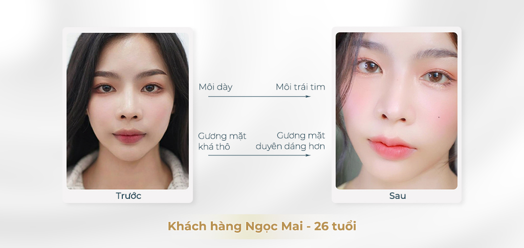 Trước và sau khi phẫu thuật môi