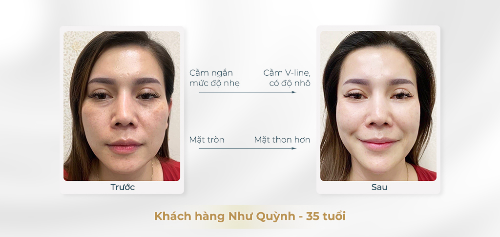 Trước và sau khi tiêm tạo hình cằm