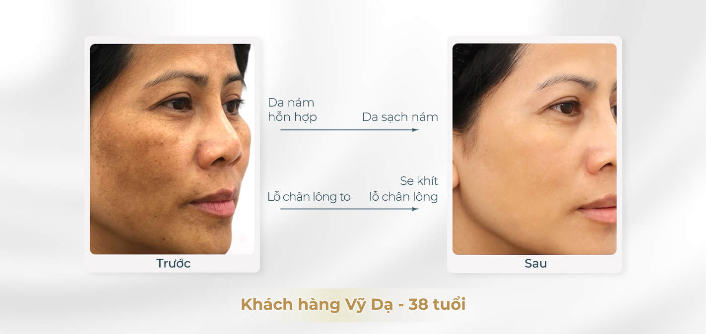 Trước và sau khi điều trị nám 2