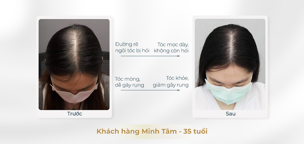Điều trị hói