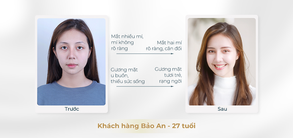 Trước và sau khi phẫu thuật mắt 2 mí