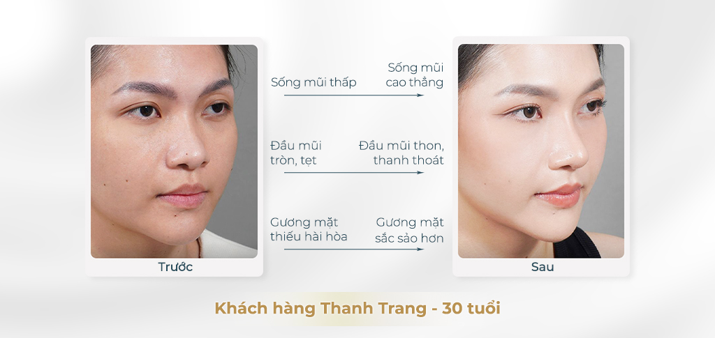 Trước và sau khi phẫu thuật mũi