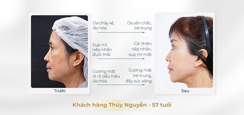 Trước và sau khi phẫu thuật căng da mặt