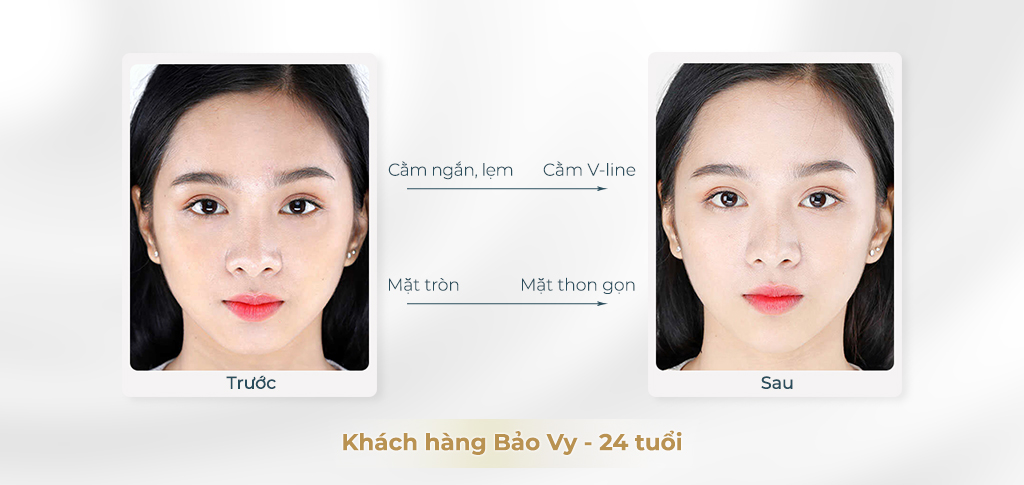 Trước và sau khi phẫu thuật cằm