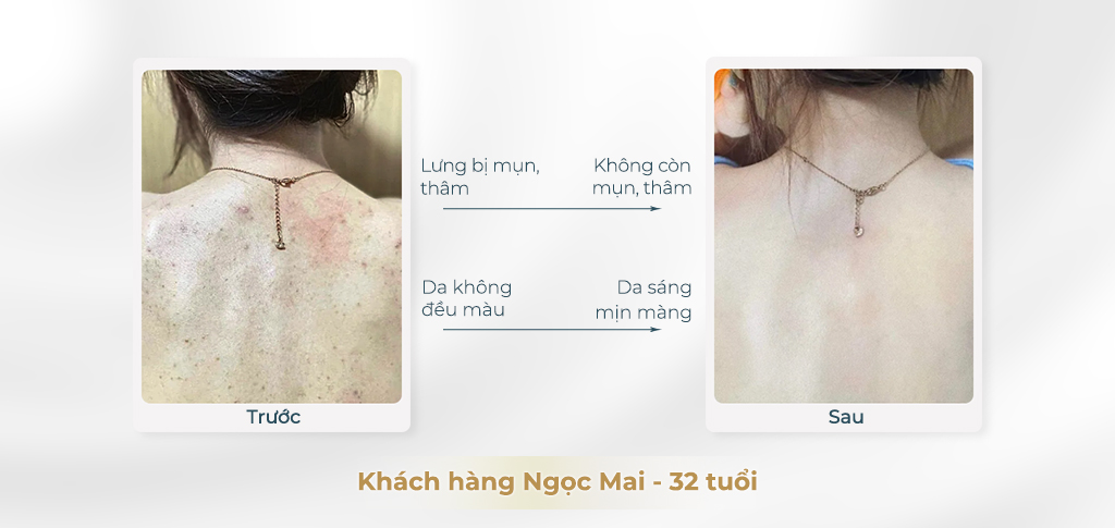 Trước và sau khi điều trị thâm
