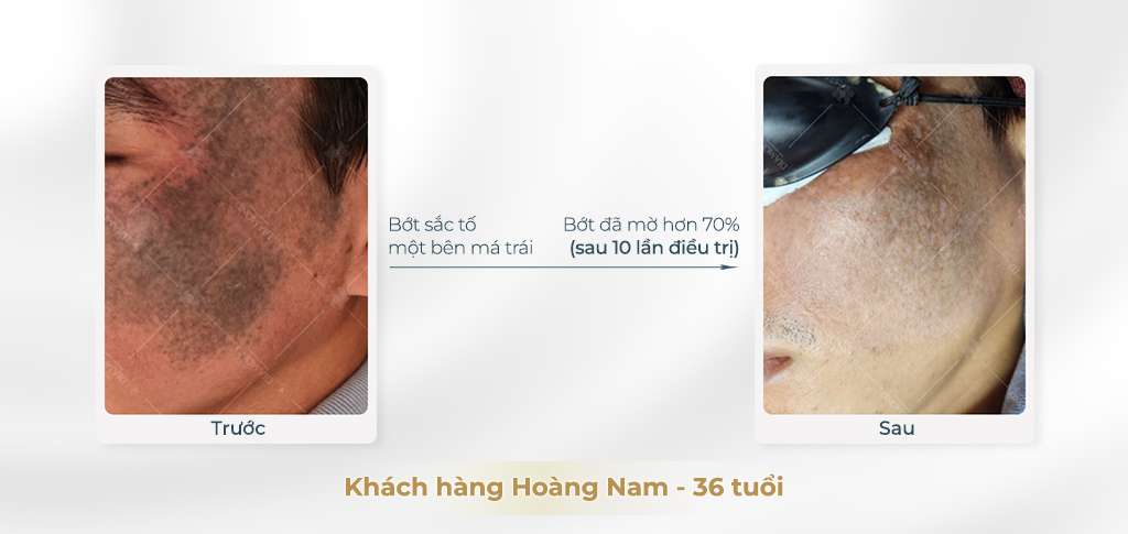 Trước và sau khi điều trị bớt sắc tố 1