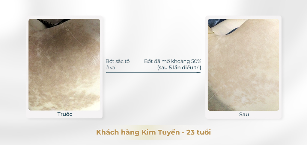 Trước và sau khi điều trị bớt sắc tố 2