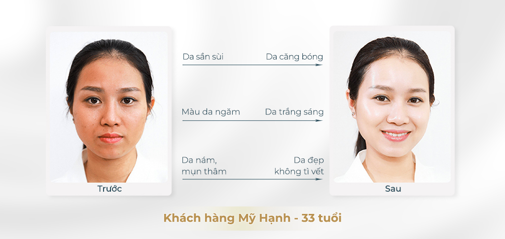 Trước và sau khi căng bóng da 1