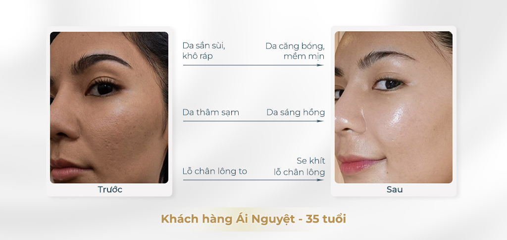 Trước và sau khi căng bóng da 2