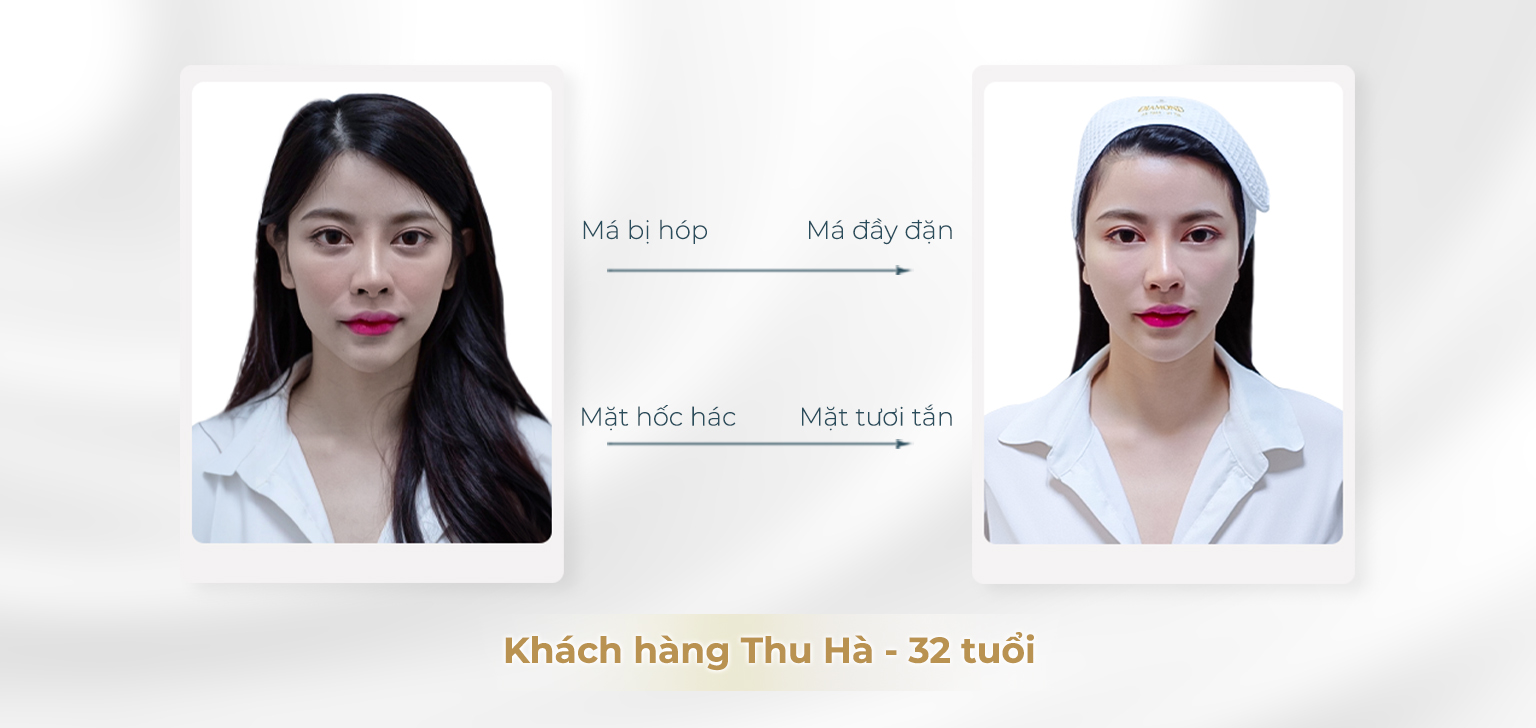 Trước và sau khi phẫu thuật làm đầy má hóp
