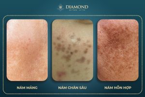 Các loại nám