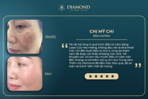 cảm nhận khách hàng sau khi điều trị nám