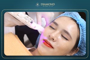 Cấy collagen tươi trị nám
