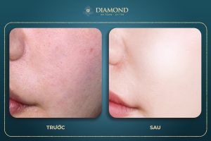 Hiệu quả dịch vụ làm căng bóng da mặt