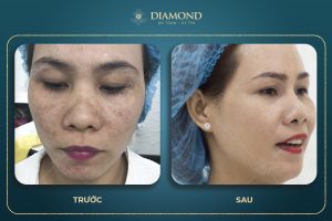 Trị nám lâu năm