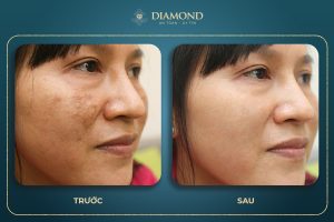 Trị nám sau 1 liệu trình