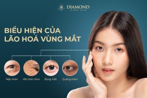 Biểu hiện lão hóa vùng mắt