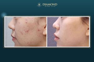 Hiệu quả trị mụn bằng laser co2