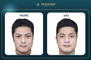 Hiệu quả trị thâm
