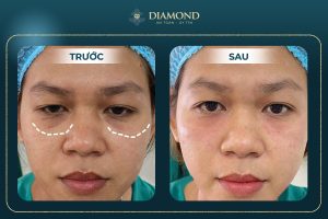 Hiệu quả trị thâm mắt