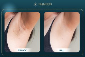 Hiệu quả trị thâm nách