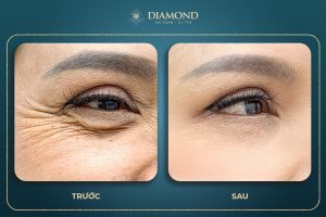 Phẫu thuật trẻ hóa vùng mắt