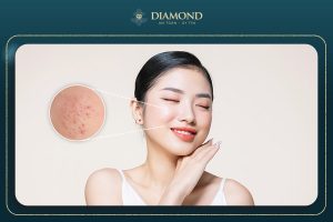 Trị mụn bằng laser CO2