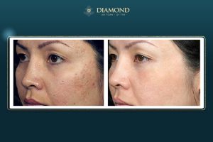 Trị sẹo rỗ bằng laser co2