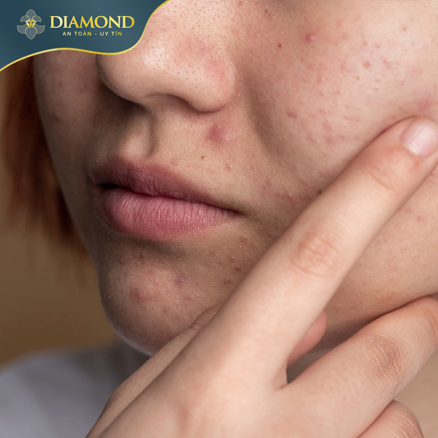 Tình trạng mụn ẩn, mụn viêm ở nữ giới do nội tiết tố thay đổi