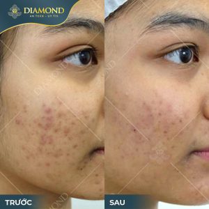 Tình trạng mụn giảm 90% chỉ sau một liệu trình điều trị tại Thẩm Mỹ Diamond.
