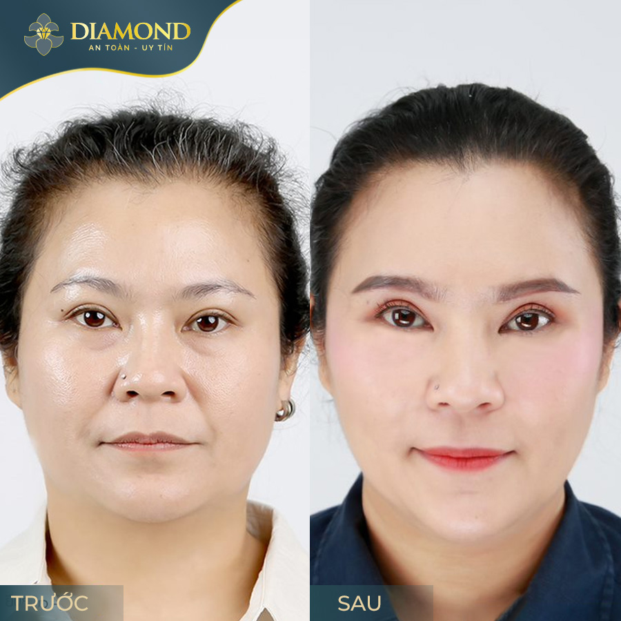 Hiệu quả trẻ hóa, xóa nhăn toàn mặt