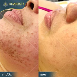 Sử dụng công nghệ cao trong quá trình điều trị mụn giúp đạt hiệu quả tối ưu, sạch mụn và giảm nguy cơ thâm sẹo.