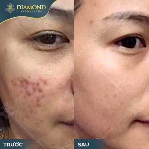 Hình ảnh trước và sau điều trị cho thấy sự khác biệt rõ rệt với làn da mịn màng.