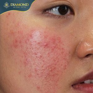 Tình trạng mụn có thể gây mất tự tin trong giao tiếp và ảnh hưởng đến tâm lý của nhiều người