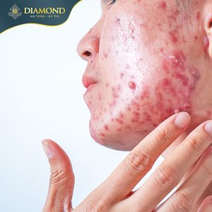 Mụn nghiêm trọng dẫn đến làn da bị viêm nhiễm nặng