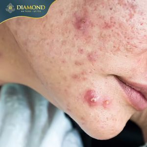 Tự nặn mụn tại nhà không chỉ không hiệu quả mà còn có thể gây sẹo rỗ trên da
