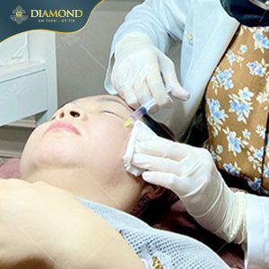 Tiêm trị mụn Meso Micro Acnes